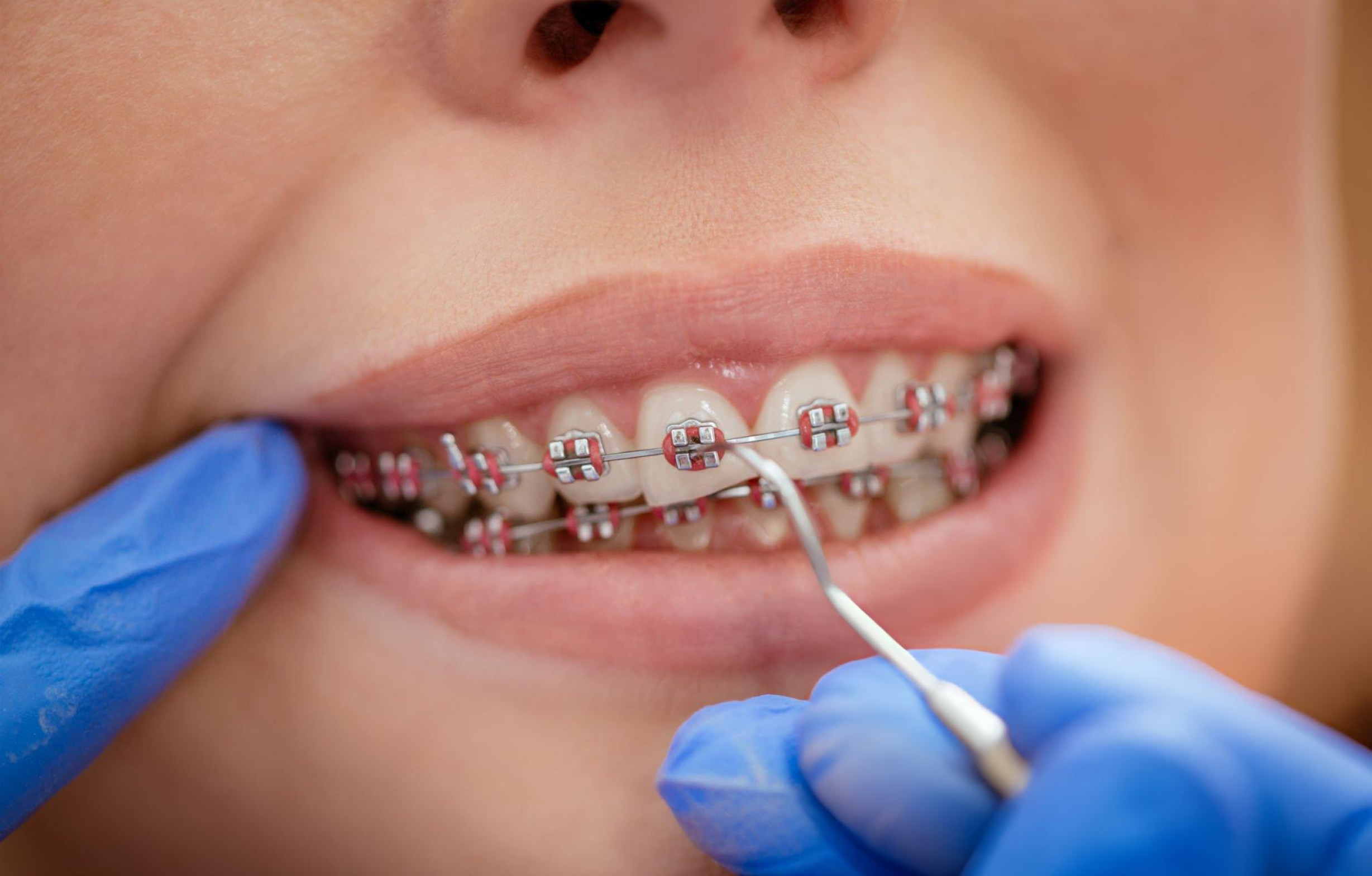 Orthodontie Enfant