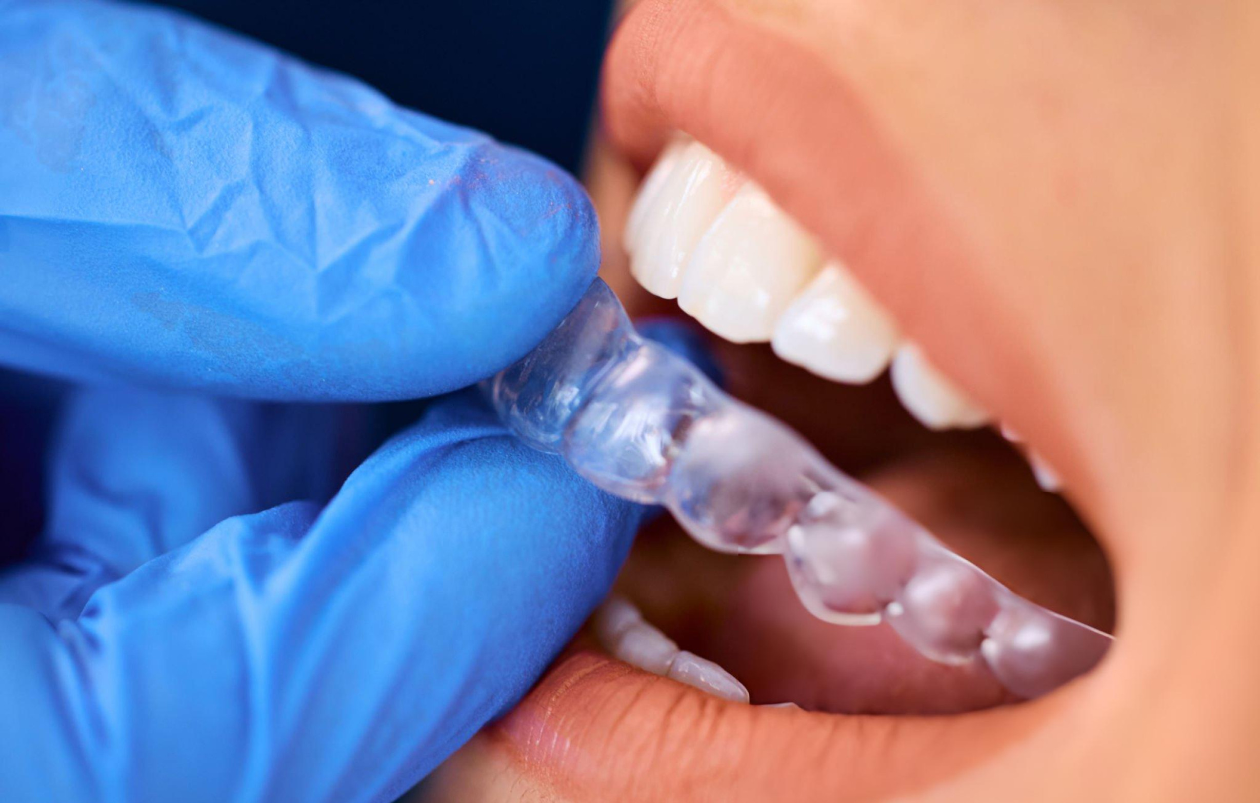 Orthodontie Invisible